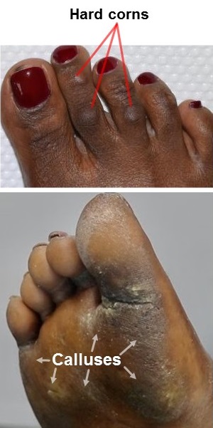 Image showing corns  and calluses on the foot